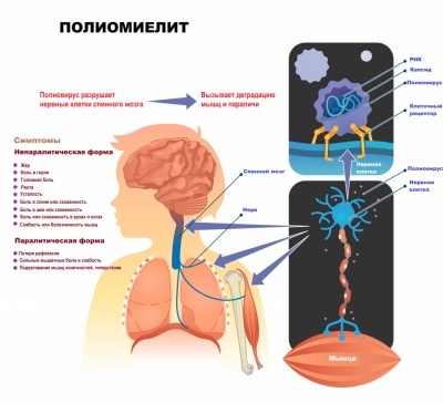 Профилактика полиомиелита